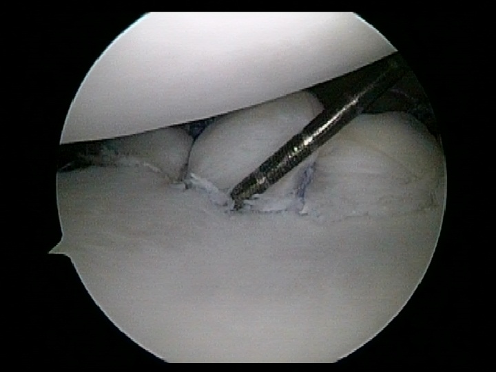 Repaired Bankart Lesion