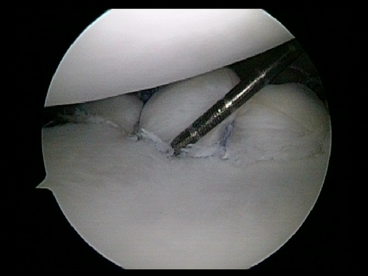 Repaired-Bankart-Leison.jpg Repaired-Bankart-Leison.jpg