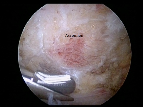 Acromion Acromioplasty