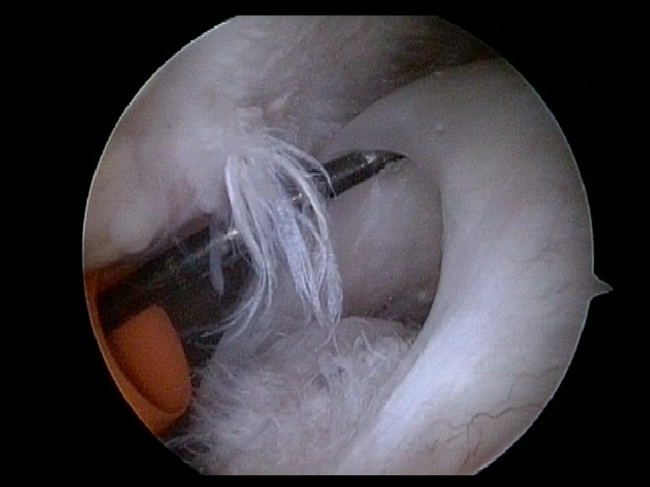 rotator cuff tear above tendon