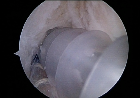 Absorbable screw being placed in femoral tunnel next to ACL graft