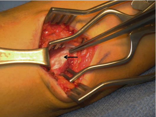 Forceps at the humeral attachment of the torn UCL white tissue