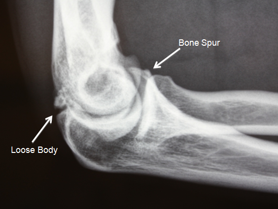 X-Ray of Loose Body and Arthritis | Elbow Arthroscopy | Dr. Khalfayan