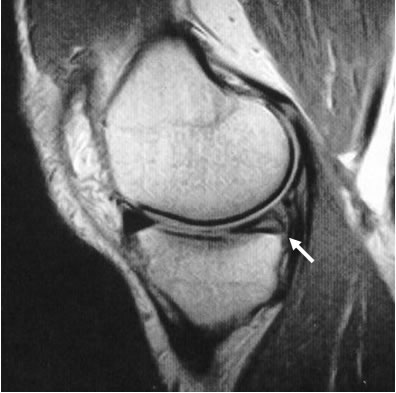 MRI showing medial meniscus tear (arrow)