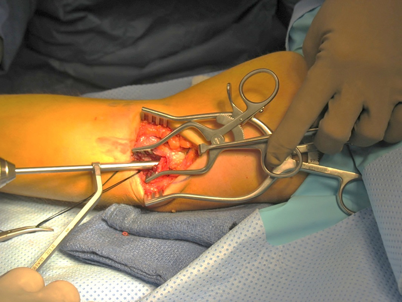 Surgical opening of humerus