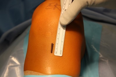 ACL Incision.JPG