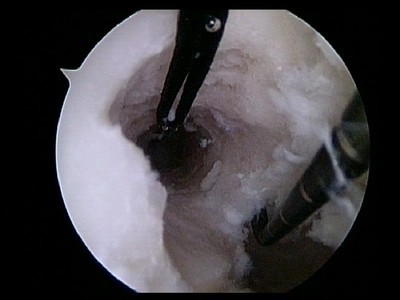 ACL Femoral Tunnel.jpg