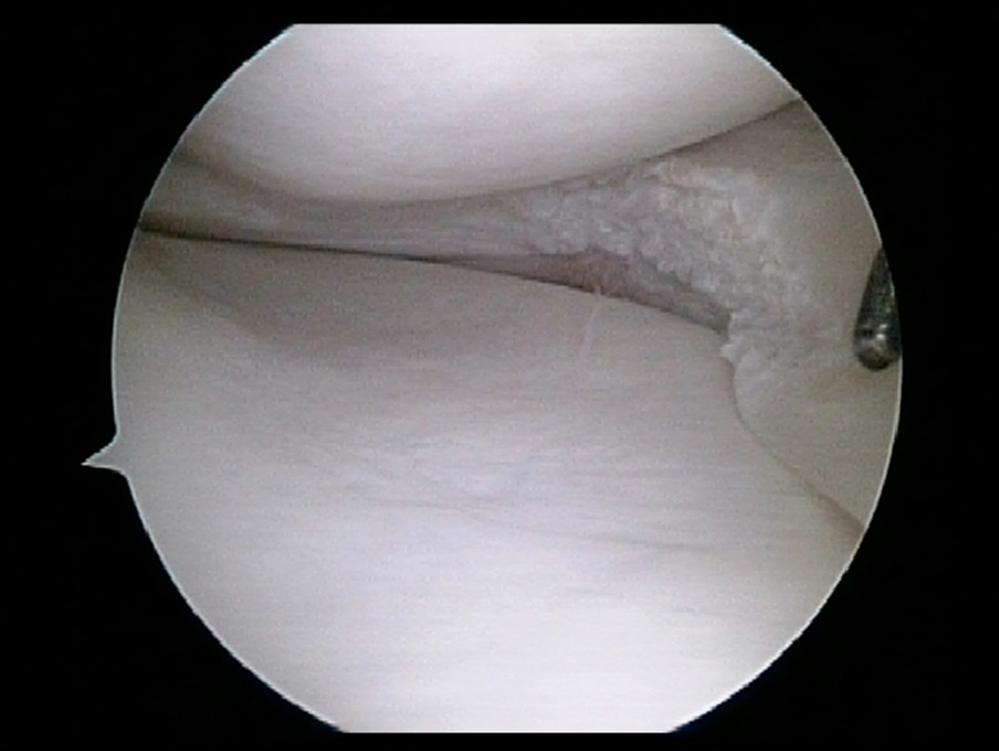 Removal of Flap Tear