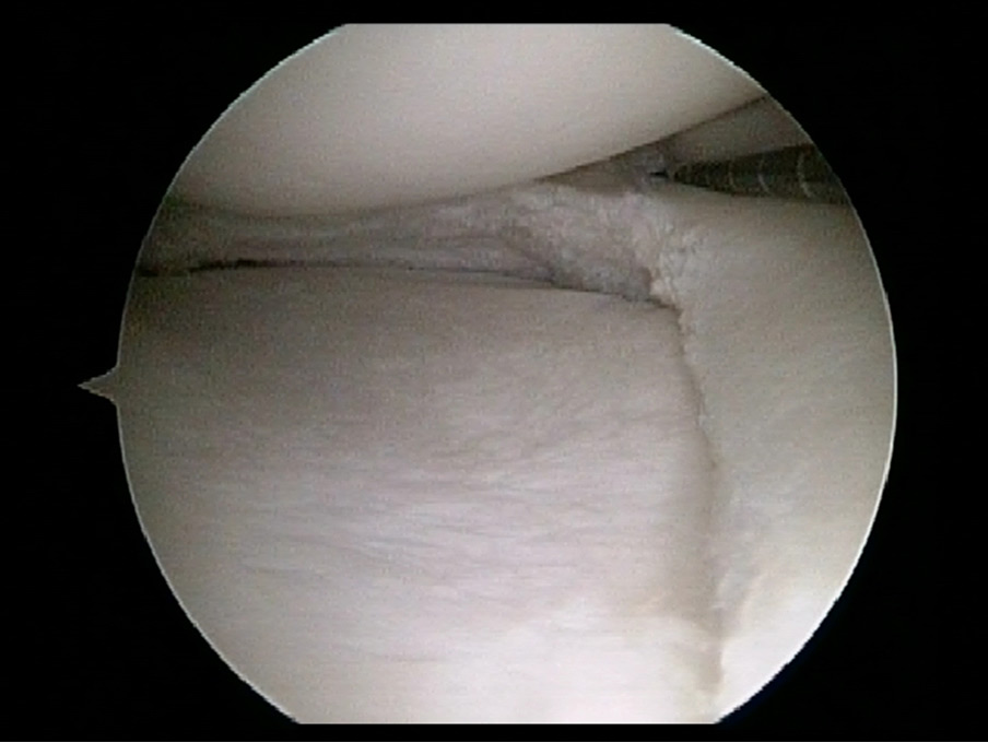 After Partial Removal of Degenerative Tear in a Runner