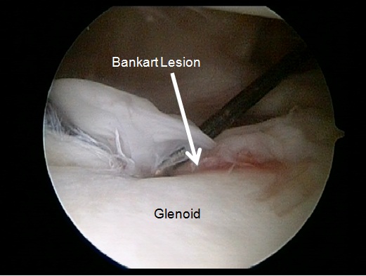 bony bankart lesion