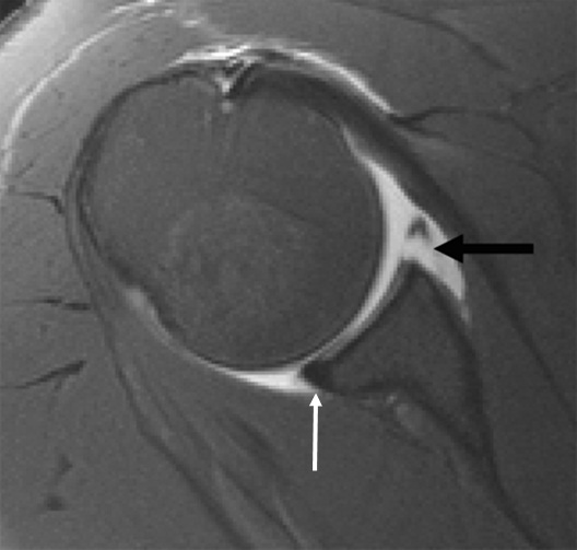 Bankart Lesion Vs Slap Tear