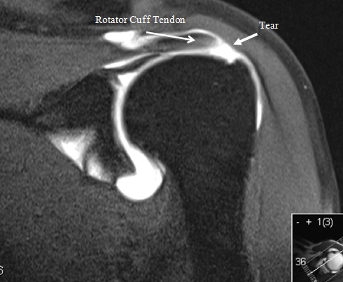 Rotator Cuff Tear - Orthopedic Specialists of Seattle