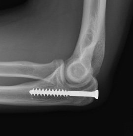 compression fracture arm