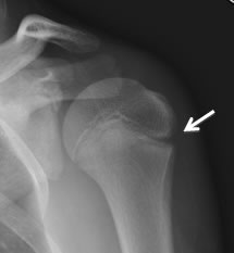 normal humerus x ray growth plates