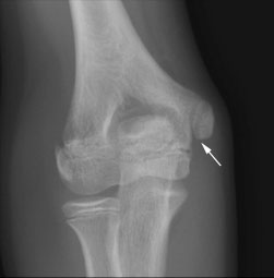 normal humerus x ray growth plates