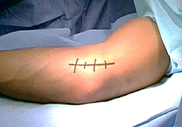 Tommy John Surgery (Ulnar Collateral Ligament Reconstruction