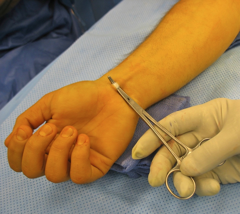 Ulnar Collateral Ligament Reconstruction (Tommy John Surgery)