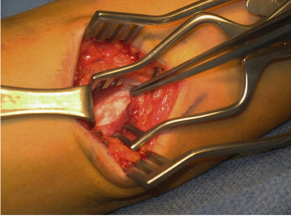 Forceps at the humeral attachment of the torn UCL (white tissue)